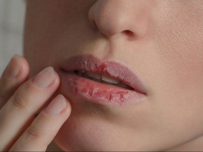 Inilah Obat Alternatif Alami untuk Atasi Bibir Pecah-pecah dan Bau Mulut