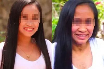 Wanita 16 Tahun Ini Alami Kondisi Langka, Kulitnya Berubah Jadi Keriput seperti Wanita Tua
