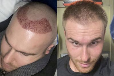 Jalani Transplantasi Rambut karena Botak, Pria Ini Akui Kepercayaan Dirinya Meledak