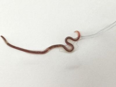 Makan Daging Mentah, Wanita di Jepang Temukan Cacing di Amandelnya