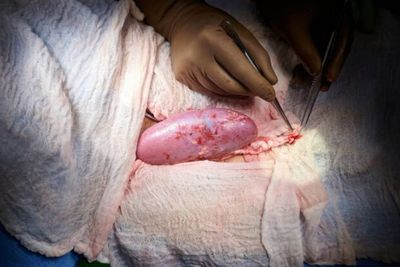 Transplantasi Ginjal Babi ke Manusia Sukses, Pakar: Wajar, Karena Secara Genetik Mirip