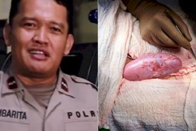 POPULER: Polda Metro Mutasi Bang Jack-Ambarita & Transplantasi Ginjal Babi ke Manusia