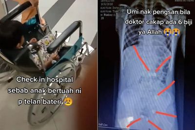 Ngeri! Bocah Ini Telan 6 Baterai, Ibunya Syok hingga Nyaris Pingsan Lihat Hasil X-Ray