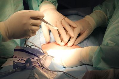 Selain Cangkok Ginjal Babi, Ini 5 Cangkok Organ yang Menuai Sorotan, Ada Cangkok Kepala!