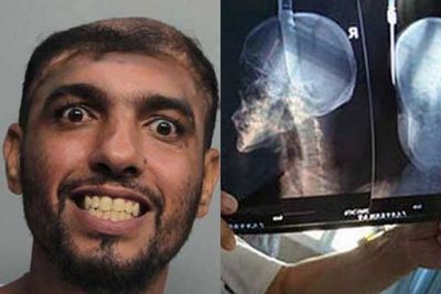 Alami Cedera Otak Parah, Orang-orang Ini Beruntung Tetap Selamat Meski Hampir Meninggal