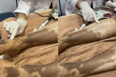 Viral Kulit Wanita Gosong karena Lotion Pemutih Abal-abal, Ini Cara Pilih Lotion yang Aman
