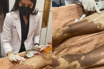 Pakai Lotion Abal-abal , Kulit Wanita Ini Malah Berubah Kemerahan & Berujung Gosong