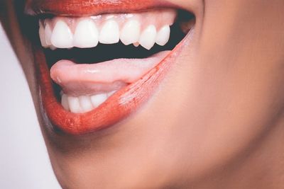 Mengenal Wisdom Teeth Impaction, Saat Gigi Tumbuh Tidak Sesuai