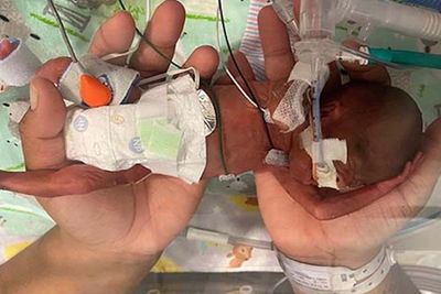 Inilah Bayi Paling Prematur di Dunia, Beratnya Hanya 420 Gram