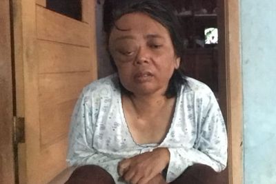 Perjuangan Warga Tasikmalaya yang Idap Tumor Mata, Tak Punya Apa-apa Lagi untuk Berobat