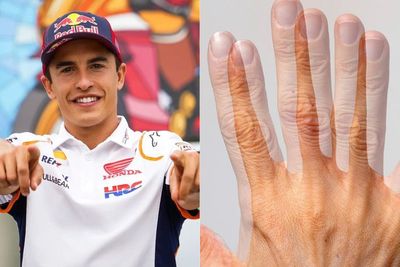 Mengenal Diplopia, Penglihatan Ganda yang Dialami Marc Marquez