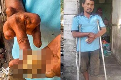 Penyakit Kusta Semakin Parah, Jari Pedagang Ikan Keliling Ini Terancam Diamputasi