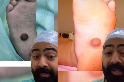 Tumbuh Puting di Telapak Kaki, Ini Penjelasan Dokter