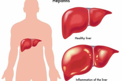 Sederet Penyebab Terjadinya Infeksi Liver, Mulai dari Virus Hingga Faktor Keturunan