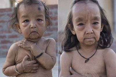 Alami Kondisi Langka, Kakak Adik di India Ini Tampak Lebih Tua dari Rekan Sejawatnya