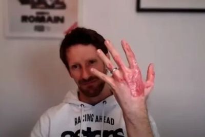 Romain Grosjean Pamer Tangan Bekas Luka Bakar Saat Kecelakaan di F1 GP Bahrain 2020