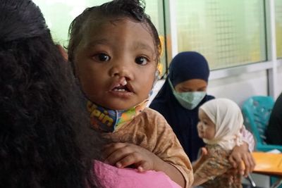 Operasi Bibir Sumbing Gratis di Papua, Berikut Foto-fotonya