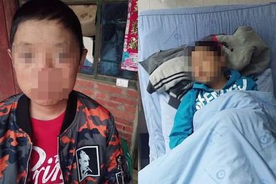 Bagai Vampir, Bocah Ini Tak Bisa Kena Sinar Matahari, Kulit Langsung Terbakar