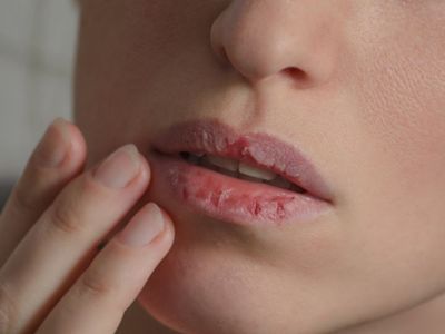 Mudah Didapat, Ini 3 Bahan Alami yang Ampuh Mengatasi Bibir Pecah-pecah