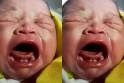 Unik! Bayi di Labura Ini Terlahir Punya Sejumlah Gigi