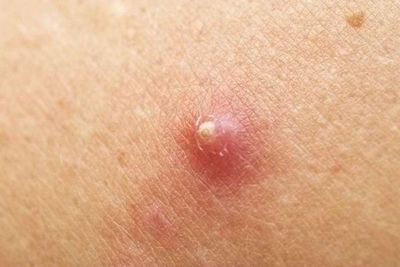 Jangan Pencet Bisul jika Ingin Cepat Sembuh