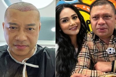Tampil Botak karena Transplantasi Rambut, Anang Hermansyah Dibilang Mirip Raul Lemos