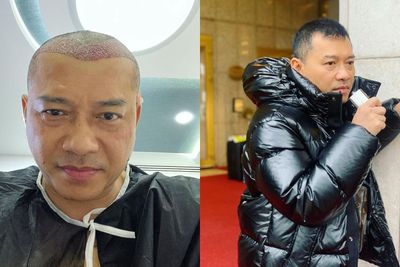 Mengenal Transplantasi Rambut yang Dilakukan Musisi Anang Hermansyah