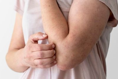 Muncul Jerawat dan Ruam di Kulit? Bisa Jadi Stres Penyebabnya!