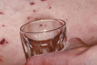 Kenali Makanan Penyebab Meningitis, Radang Selaput Otak yang Bisa Sebabkan Kematian