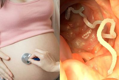 Bukan Belatung, Cacing Kremi yang Bisa Hidup di Organ Intim Wanita, Ini Cara Mencegahnya