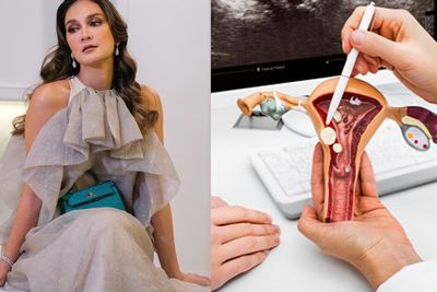 Luna Maya Bekukan Sel Telur Dirinya, Begini Manfaat dan Efek Sampingnya