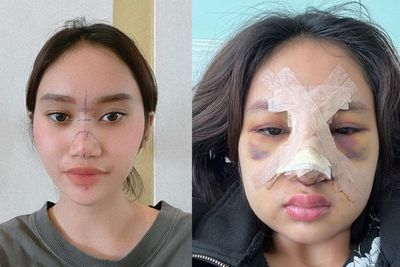 Potret Wajah Lebam Anak Food Vlogger Farida Nurhan usai Operasi Plastik