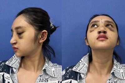 Hasil Operasi Plastik Dhyaz Anak Farida Nurhan, Netizen Soroti Bentuk Hidungnya