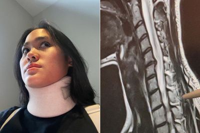 Penyebab Saraf Kejepit seperti yang Dialami Sheryl Sheinafia, Salah Satunya Obesitas