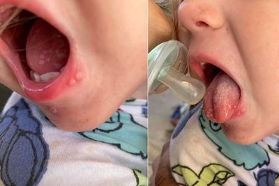 Kasihan! Balita Ini Terkena Herpes setelah Dicium, Bikin Susah Makan dan Minum