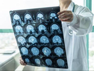 Waspada! Meski Bergejala Ringan, Ahli Sebut Omicron dapat Picu Kerusakan Fatal pada Otak