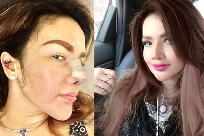 Habiskan Ratusan Juta, Ini 5 Potret Terbaru Barbie Kumalasari Usai 6 Kali Operasi Hidung