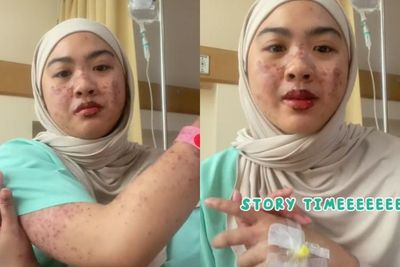 Viral Wanita Alami Ruam di Sekujur Tubuh usai Minum Obat saat COVID-19: Bibir Perih