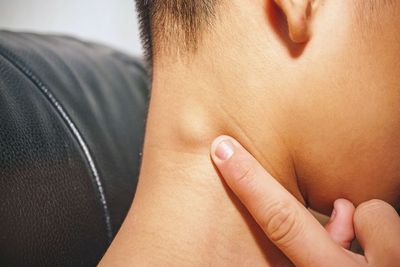 Kelenjar Getah Bening: Penyebab, Ciri-Ciri, dan Cara Mengobatinya