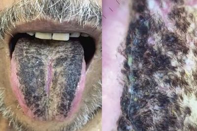 Lidah Pria Ini Ditumbuhi Rambut Hitam Tebal, Penampakannya Bikin Mengernyitkan Dahi