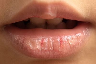 Jilati Bibir yang Kering saat Puasa hanya Bikin Bibir Tambah Kering, Ini Sebabnya