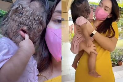 Kisah Ibu yang Tetap Ikhlas dan Bangga Walau Anak Perempuannya Berbulu karena Sindrom Ini
