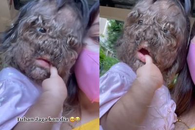 Mengenal Hypertrichosis, Sindrom Langka yang Bikin Wajah Balita Ini Penuh dengan Rambut