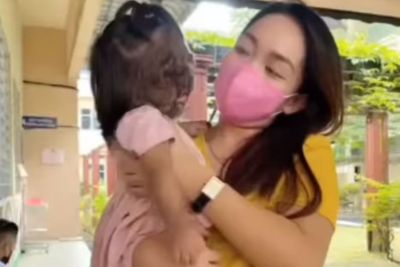 Gejala dan Penyebab Sindrom Manusia Serigala yang Bikin Anak Jadi Berbulu, Bisa Dicegah