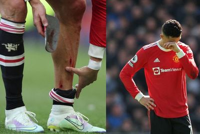 MU Kalah, Kaki Ronaldo Berdarah hingga Berujung Banting HP Fans Everton