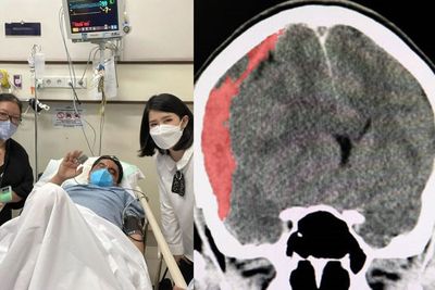 Ade Armando Alami Pendarahan Otak Usai Dikeroyok, Ini Kemungkinan Terburuknya