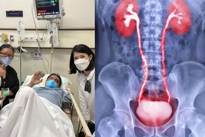 Selain Pendarahan Otak, Ade Armando juga Menderita Gangguan Kandung Kemih, Seperti Apa?