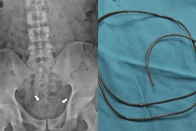 Ngeri, Dokter Temukan Kabel Sepanjang 80 Cm di Kandung Kemih Pria Akibat Aktivitas Seksual