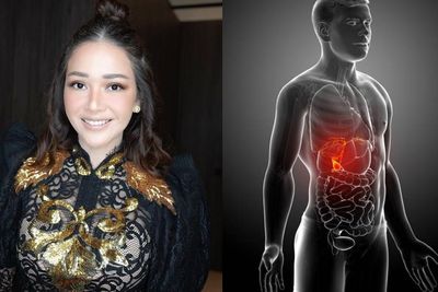 Sempat Alami GERD, Maia Estianty Kini Jalani Operasi Batu Empedu, Bagaimana Prosedurnya?