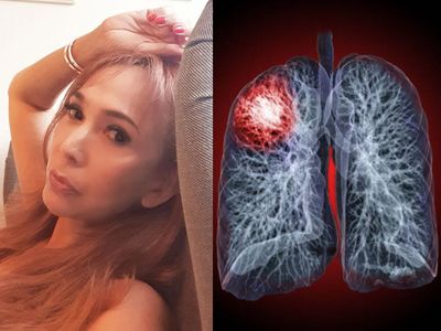 Jadi Penyebab Meninggalnya Kiki Fatmala, Kenali 8 Gejala Kanker Paru yang Sering Diabaikan